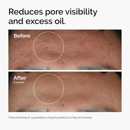 The Ordinary Niacinamide 10% + Zinc 10%